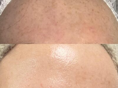 Pigmentation Treatment