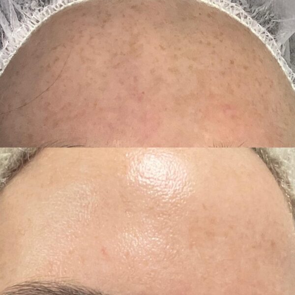 Pigmentation Treatment